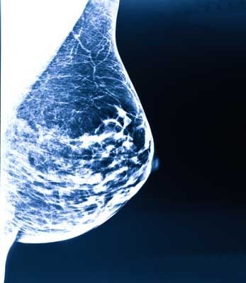 breast-cancer-stages